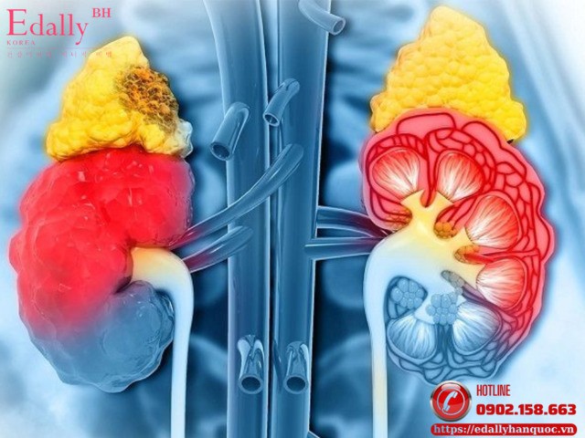 Bệnh nhân cường aldosterone nào không cần làm thăm dò lấy máu tĩnh mạch thượng thận (AVS)?